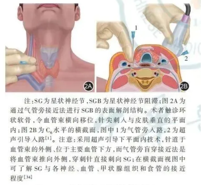 星状神经节阻滞（SGB）：调节自主神经系统，改善睡眠障碍的创新疗法